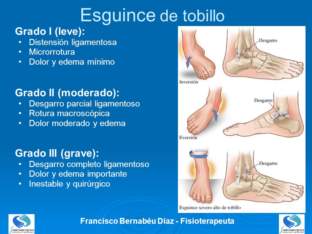 esguince tobillo grado 1 tiempo recuperacion